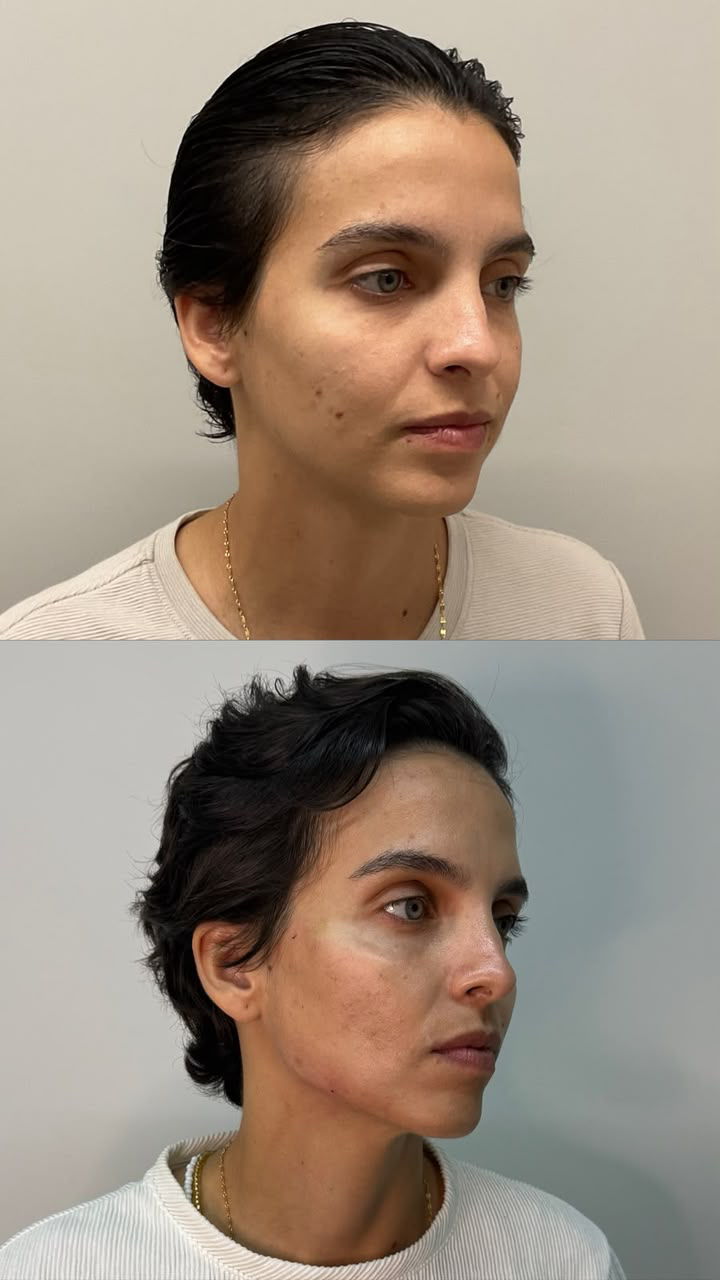 Antes e depois — Preenchimento malar e mandíbula