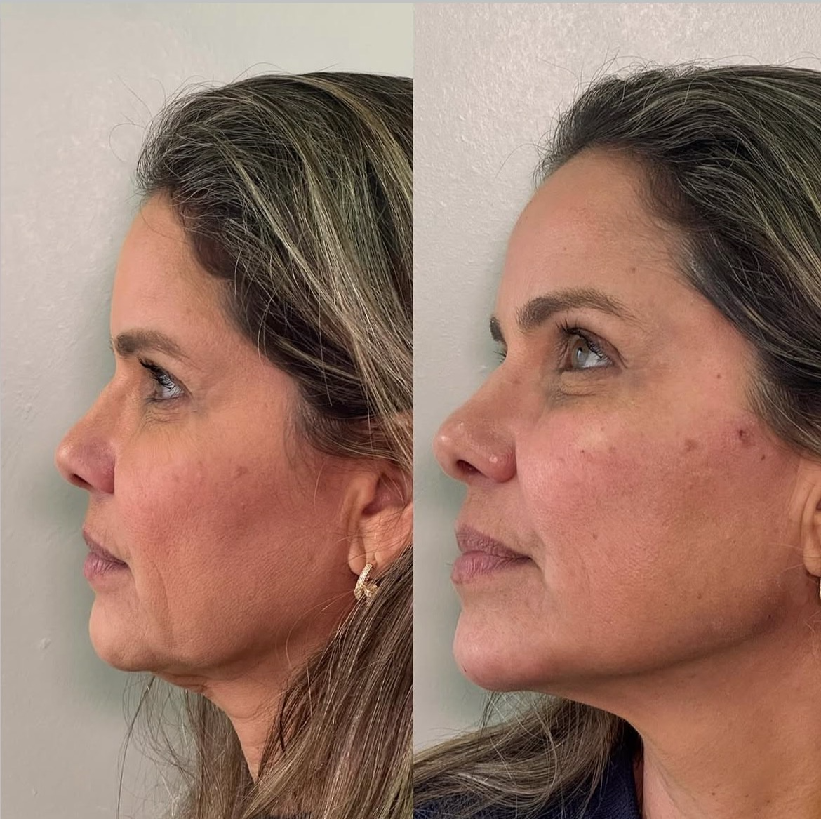 Antes e depois — Preenchimento malar e mandíbula