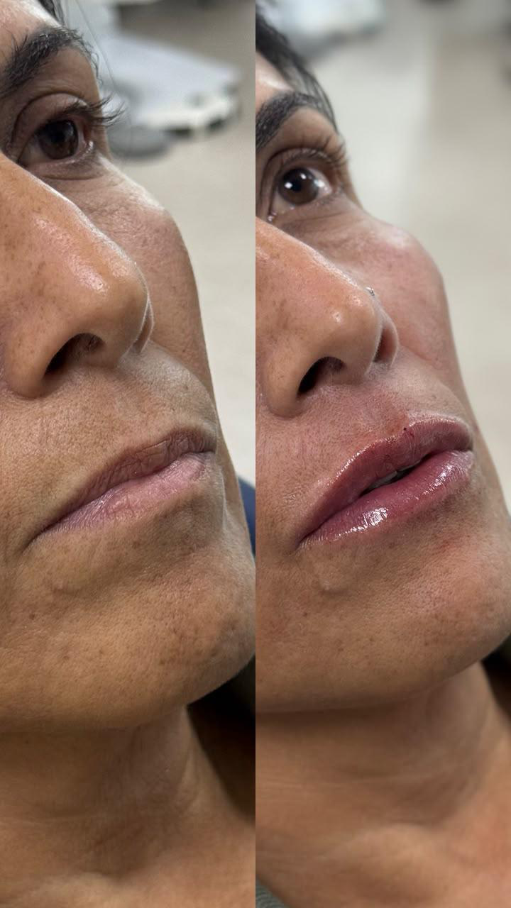 Antes e depois — Preenchimento labial