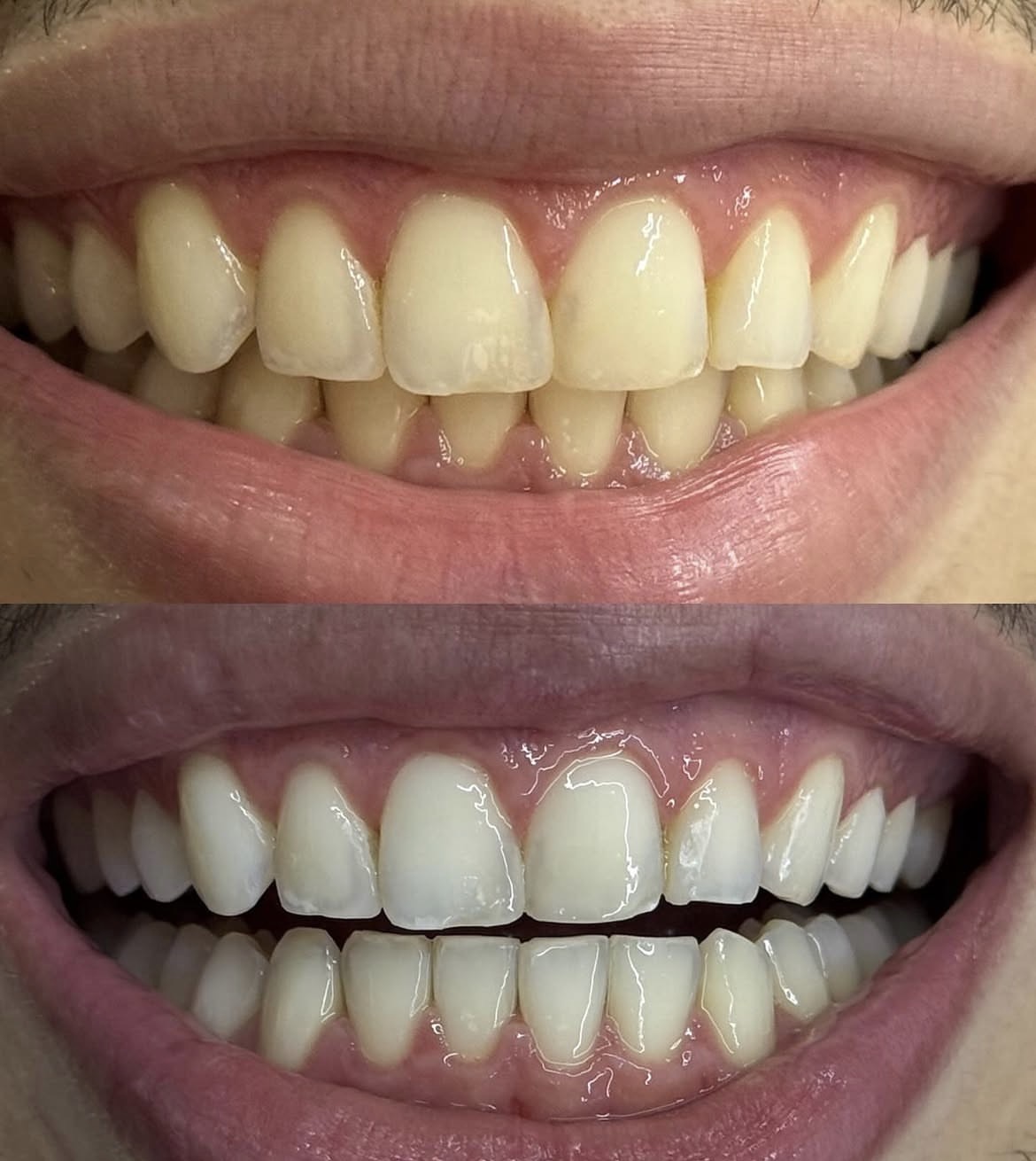 Antes e depois — Estética do sorriso
