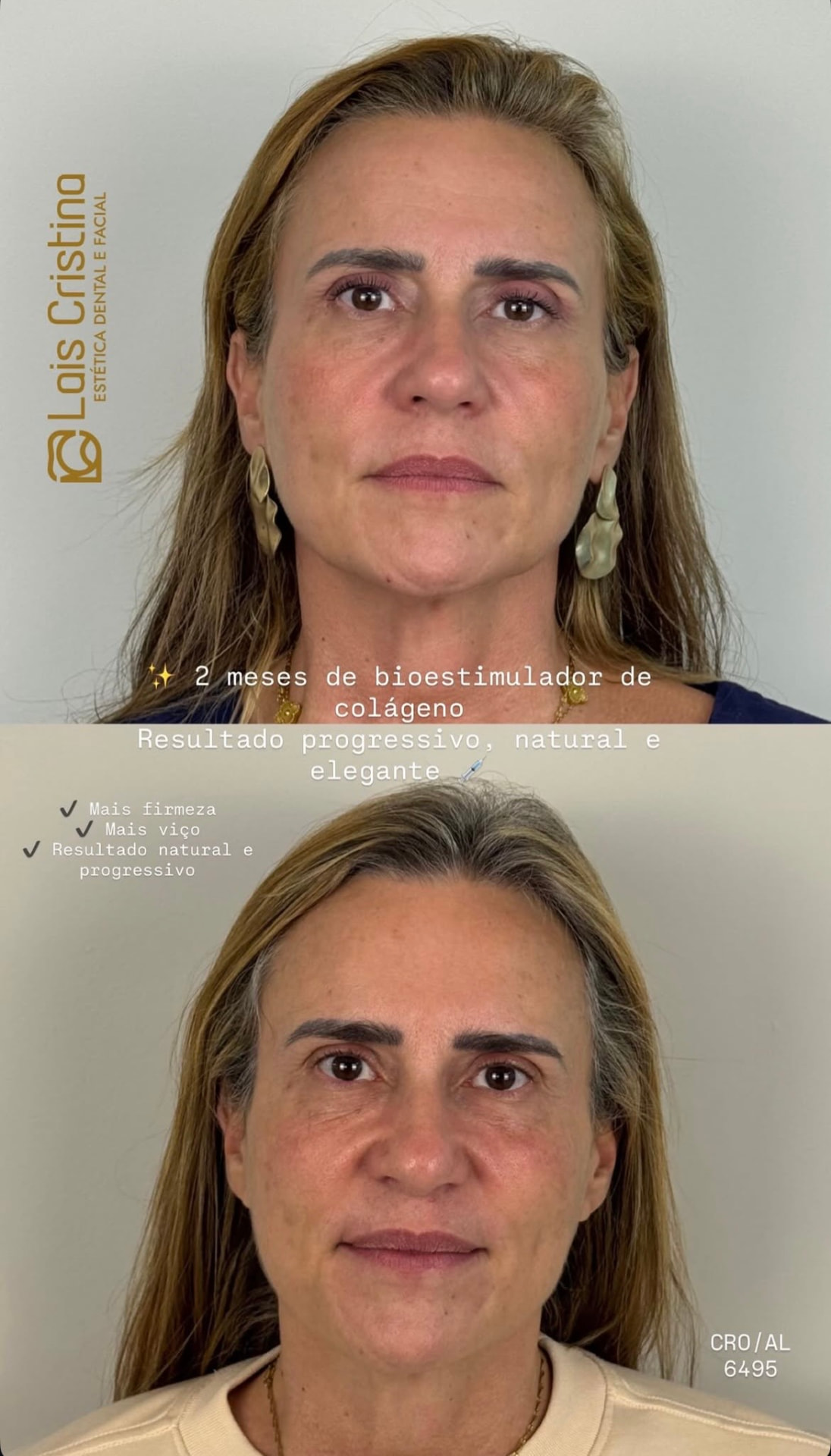 Antes e depois — Bioestimulador de colágeno
